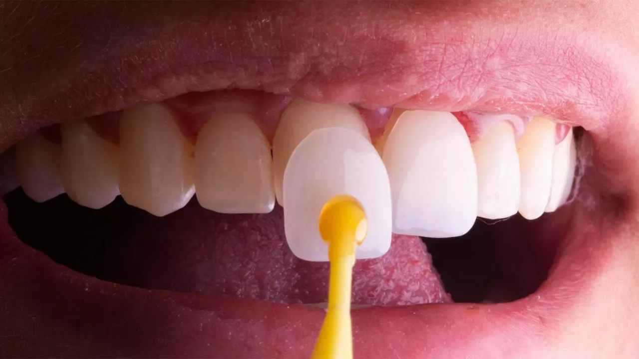 ¿Puede el Trometamina de Ketorolaco ayudar con el dolor dental? Un vistazo más de cerca
